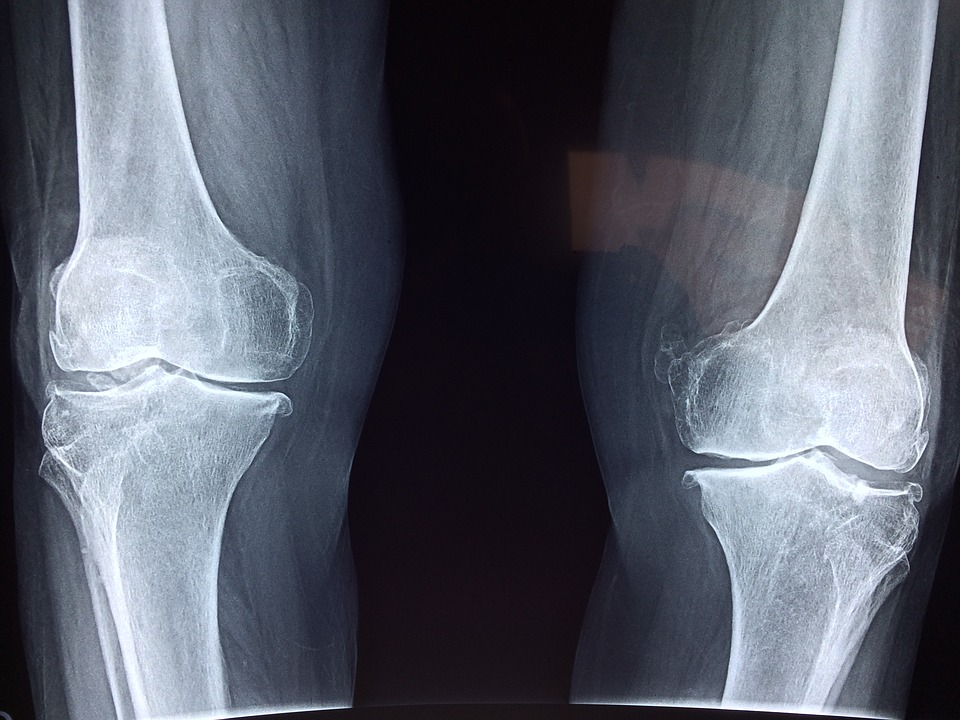 You Don't Have to Resort to Knee Surgery - Regenerative Medicine Can Help