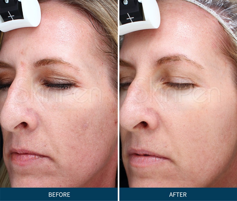 Chronic Care of Richmond offers affordable and effective microneedling facial near you in Richmond.