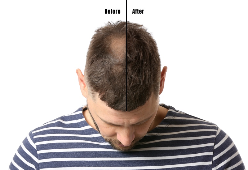 Chronic Care of Richmond offers a non-surgical and miminally invasive solution to hair loss treatments.