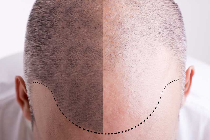 Chronic Care of Richmond is a non-surgical hair restoration clinic in Richmond that offers PRP hair restoration therapies.