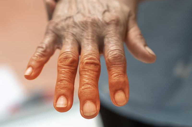 Arthritis is painful and weather can make it worse - learn more with Chronic Care of Richmond.